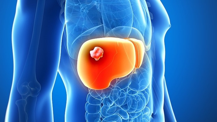 肝癌早期症状和征兆有哪些？负离子理疗仪是肝癌患者的“救星”！