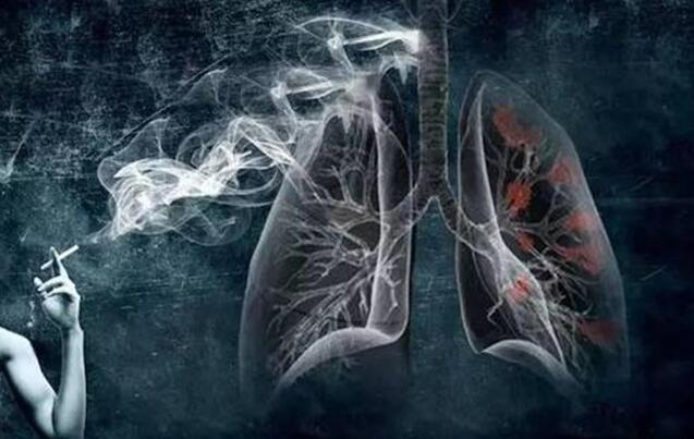肺癌死亡率高，使用负离子理疗仪防治肺癌很有必要