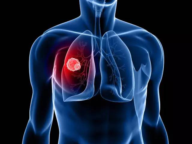 得了肺癌还有办法治疗吗?负氧离子治疗肺癌比“偏方”好使