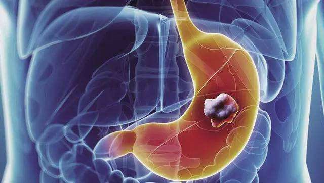 負離子理療儀真的能有效抑制癌細胞擴散嗎？負離子提高胃癌晚期患者的治愈率！