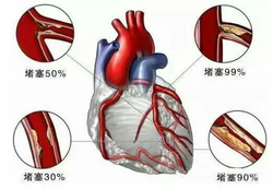 負氧離子：心腦血管疾病的調理專家