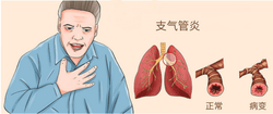 支气管炎患者的福音：负离子生成机